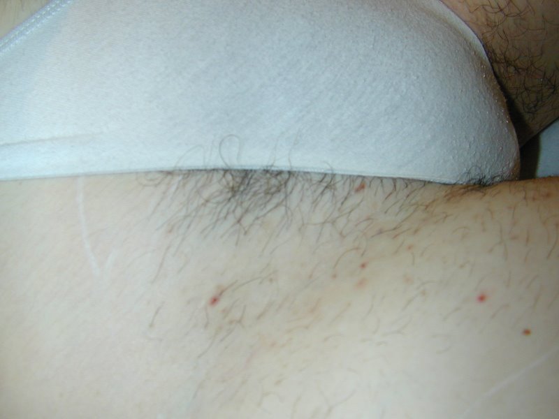 Before Laser Hair Reduction Treatment